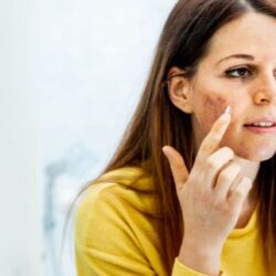 acne scar treatment - citrine clinic