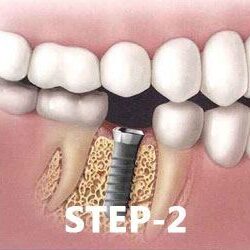 Dental-Implants-Surgery-1