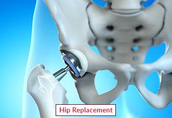 1681194806hip-replacement 1681194806hip-replacement
