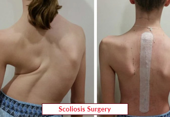 1680704981scoliosis-spine-surgery (3) 1680704981scoliosis-spine-surgery (3)