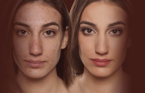 acne-treatments-before-after-updated acne-treatments-before-after-updated