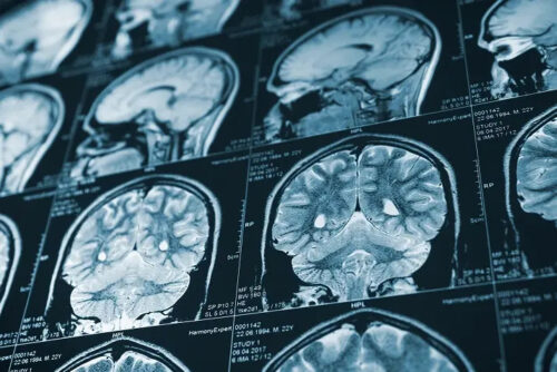 braininjurylawyerranchocucamonga braininjurylawyerranchocucamonga