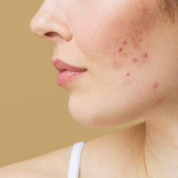 Skin Care Clinic Maple Ridge