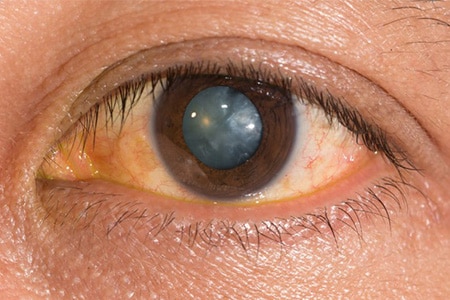 cataract cataract