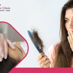 Best Hair Loss Treatment In Bangalore