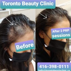 PRP+HAir+restoration+Before+after+8