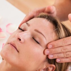 Acupuncture