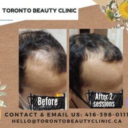 PRP+HAir+restoration+Before+after+2