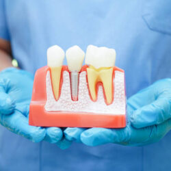 dental implant