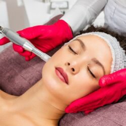 Microneedling Treatment in San A