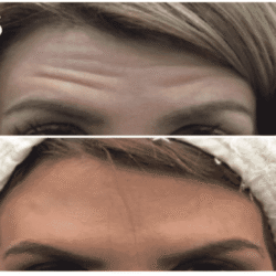 Botox