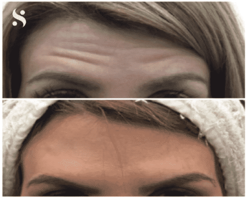 Botox Botox