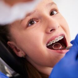 Braces Treatment