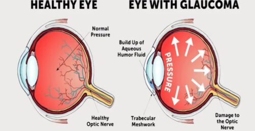 glaucoma img glaucoma img
