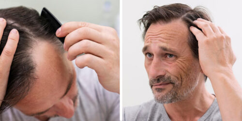 Receding Hairline Vs Mature Hairline Receding Hairline Vs Mature Hairline