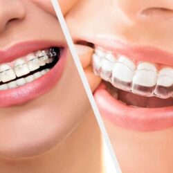 braces-aligners (1)