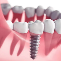 dental-implant
