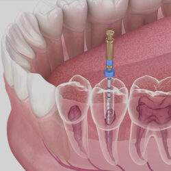 root-canal-treatment.