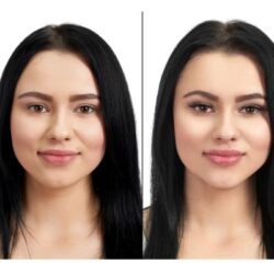 _PRP treatment for face before and after