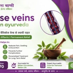 Varicose veins treatment in ayurveda_