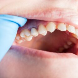 Gum-Disease-Treatment