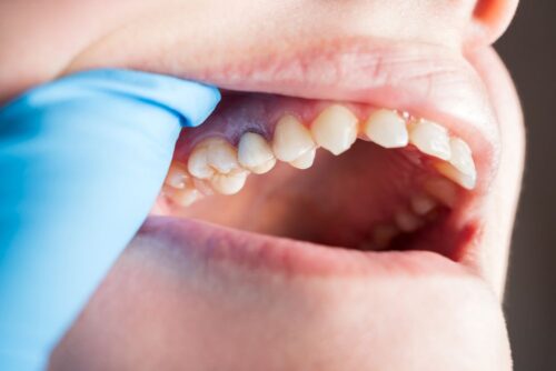 Gum-Disease-Treatment Gum-Disease-Treatment
