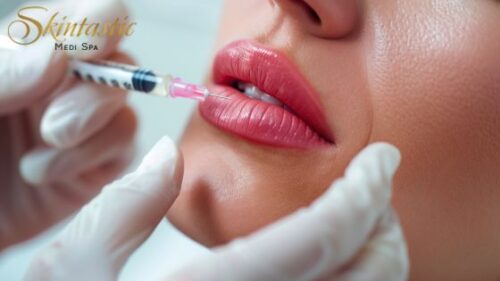 Lip Fillers Riverside for a Youthful Look Lip Fillers Riverside for a Youthful Look