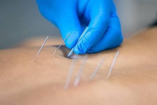 Dry Needling Services Dry Needling Services
