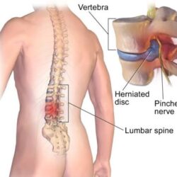 Spinal Rehabilitation Treatment