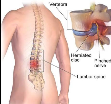 Spinal Rehabilitation Treatment Spinal Rehabilitation Treatment
