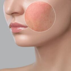 rosacea treatment