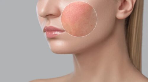 rosacea treatment rosacea treatment