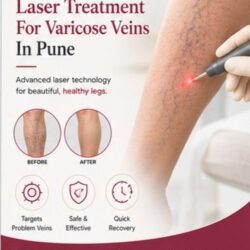Laser Treatment For Varicose Veins In Pune - Karishma Vein Clinic