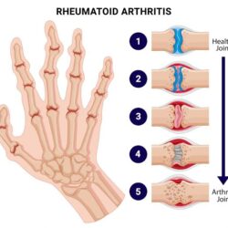 Rheumatoid Arthritis Treatment