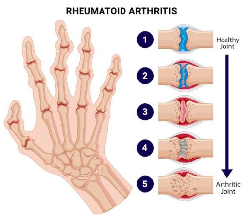 Rheumatoid Arthritis Treatment Rheumatoid Arthritis Treatment