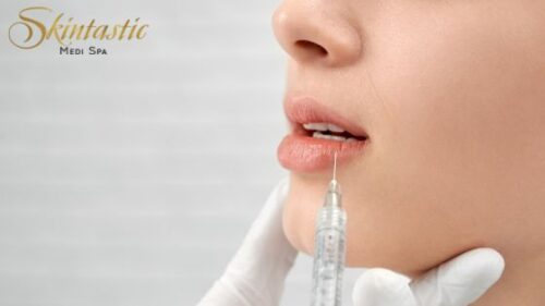 Lip Fillers CA Lip Fillers CA