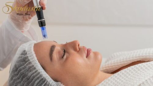 Potenza Microneedling in Riverside Potenza Microneedling in Riverside