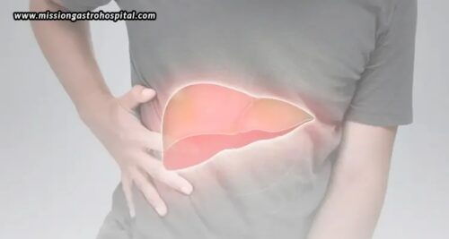 Men & Fatty Liver Disease – A Growing Health Issue Men & Fatty Liver Disease – A Growing Health Issue