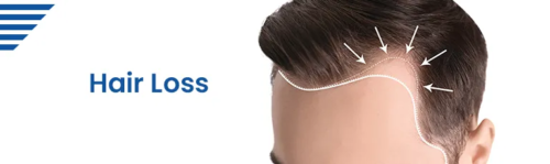 hair-loss hair-loss