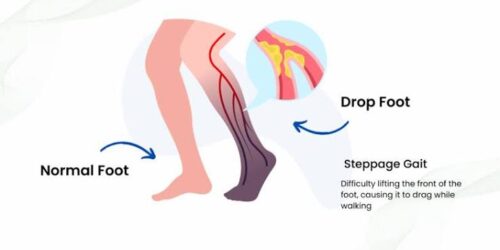 Foot Drop Treatment in Gurgaon Foot Drop Treatment in Gurgaon