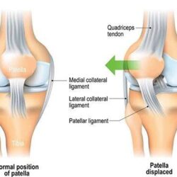 Chondromalacia Patella Treatment