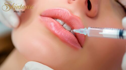 Smile Naturally with Lip Fillers Riverside Smile Naturally with Lip Fillers Riverside