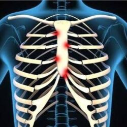 Costochondritis Physiotherapy Treatment