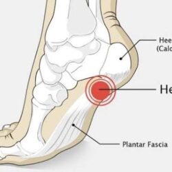 Calcaneal Spur Treatment in Gurgaon