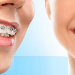 Confident Adult Smiles with Modern Orthodontic Care in West Covina