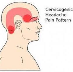 Cervicogenic Headaches Treatment