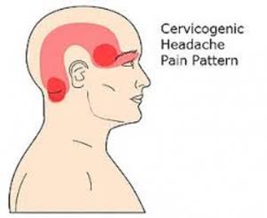 Cervicogenic Headaches Treatment Cervicogenic Headaches Treatment