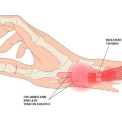 De Quervain Tenosynovitis Treatment