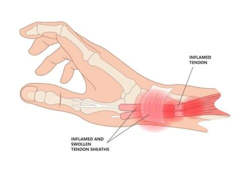 De Quervain Tenosynovitis Treatment De Quervain Tenosynovitis Treatment