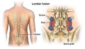 Lumbar Spinal Stenosis Lumbar Spinal Stenosis